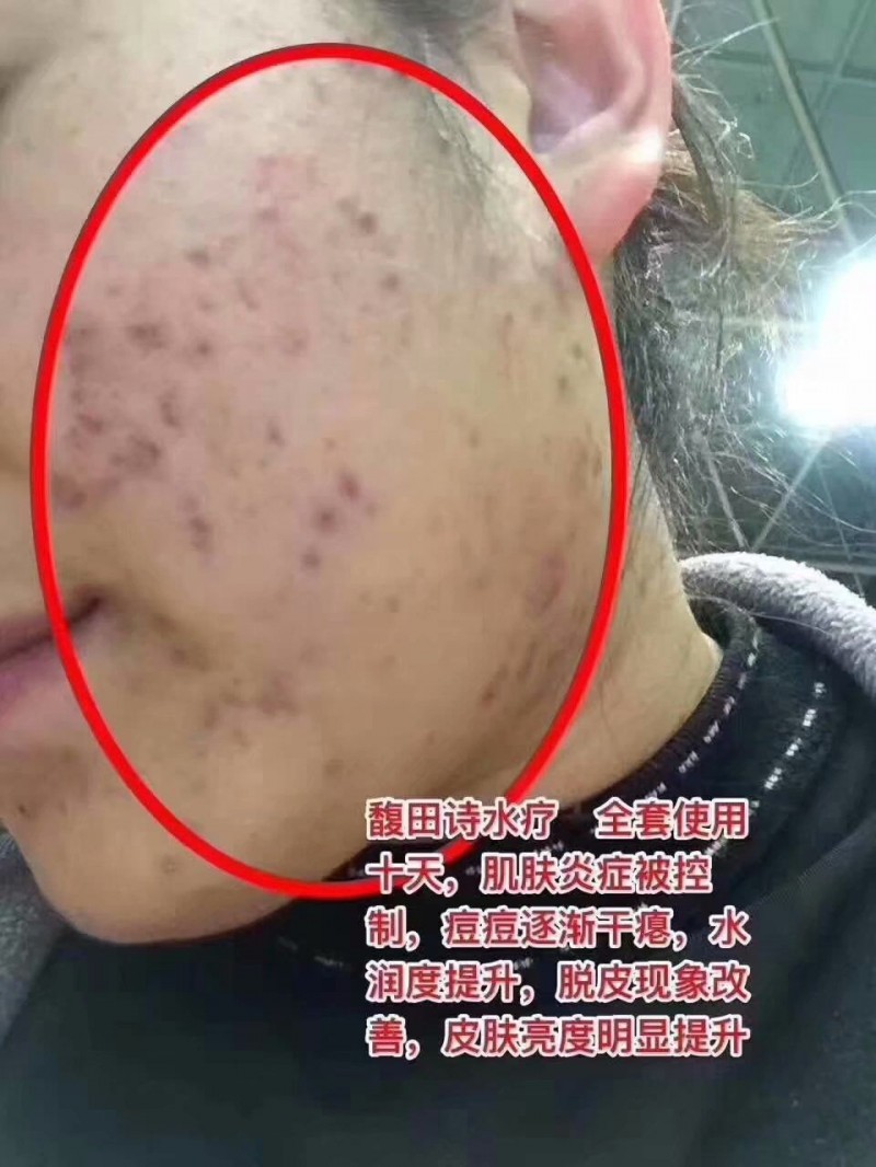 馥田詩水療，全套使用十天，肌膚炎癥被控制，痘痘逐漸干癟，水潤度提升，脫皮現(xiàn)象改善，皮膚亮度明顯提升。